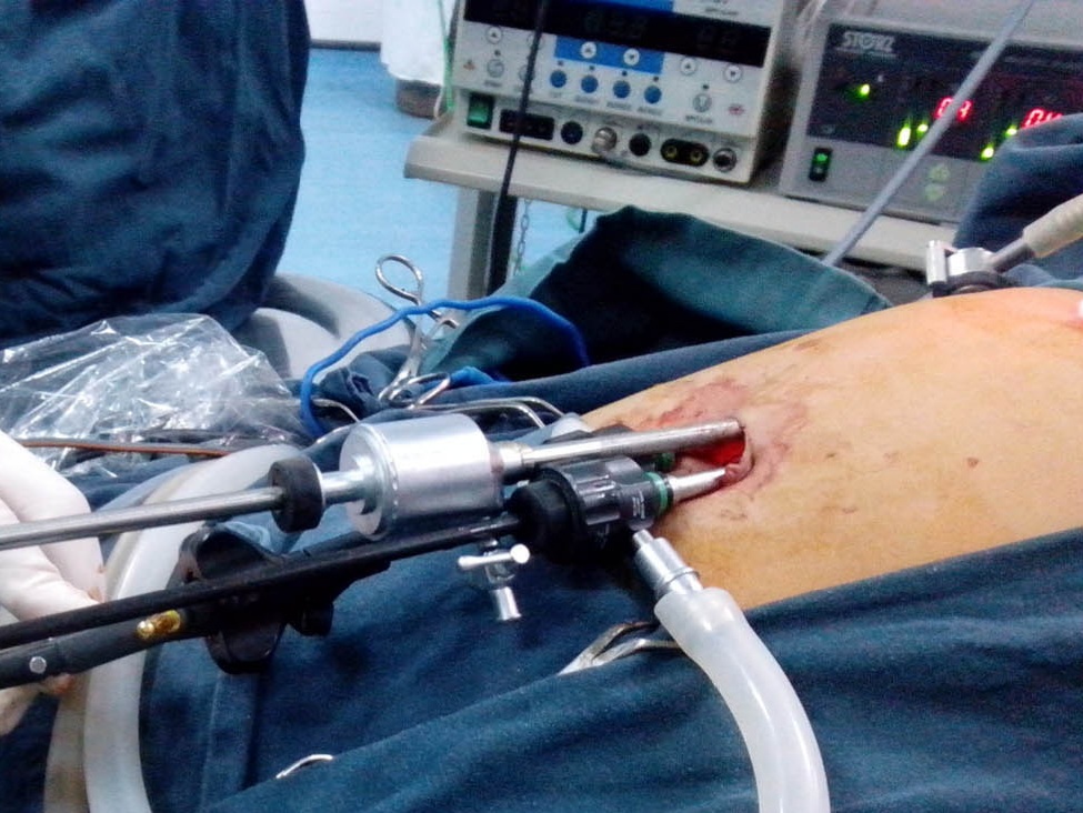 Phẫu thuật nội soi điều trị thoát vị bẹn cho trẻ em tại trung tâm Kỹ thuật cao