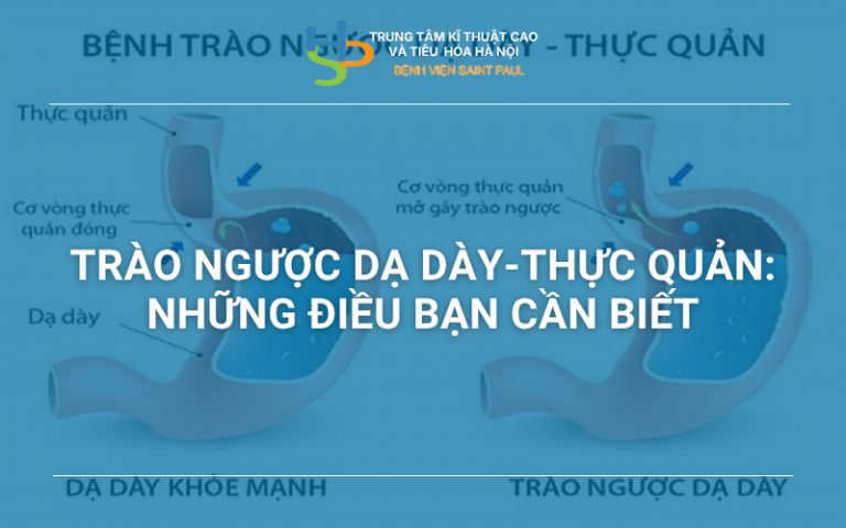 Trào ngược dạ dày - thực quản