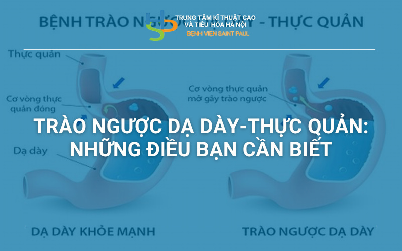 Trào ngược dạ dày - thực quản