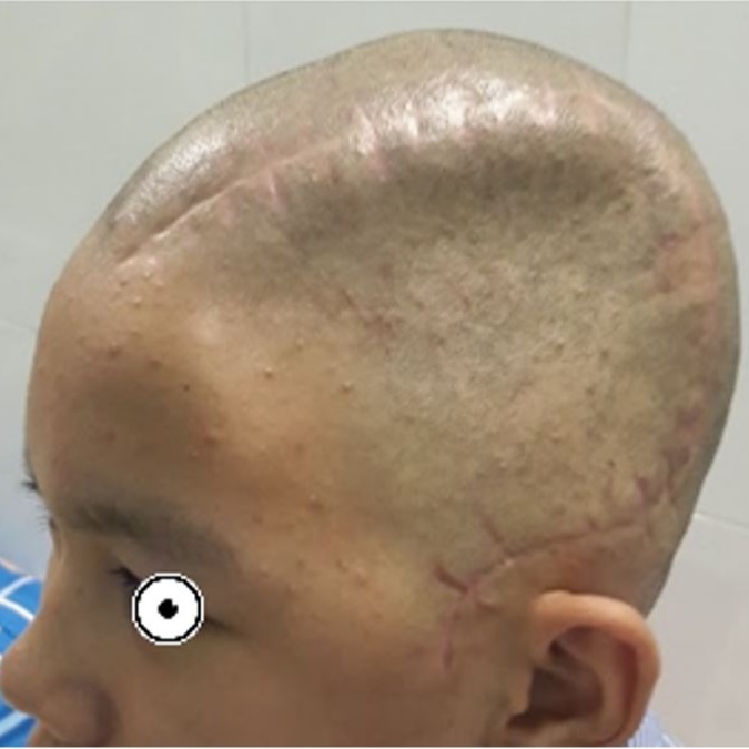 Phẫu thuật đặt lại xương sọ kết hợp tạo hình bằng lưới Titanium