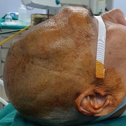 Phẫu thuật ghép sọ tự thân (đặt lại bản sọ)