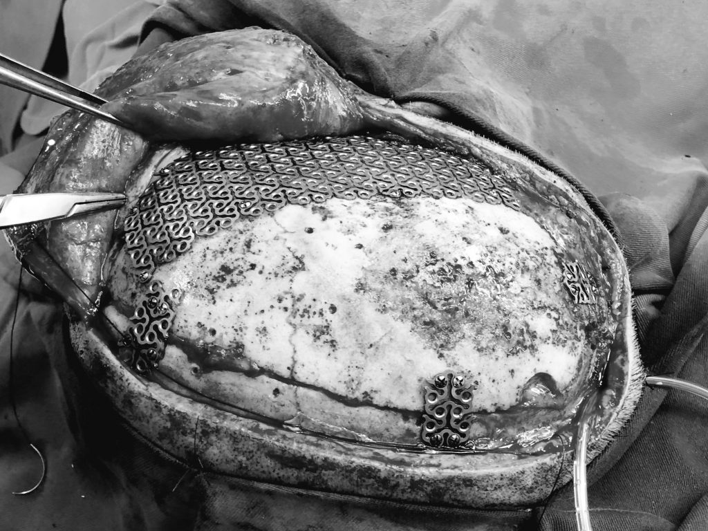 Phẫu thuật tạo hình hộp sọ hỗn hợp tự thân kết hợp Titanium