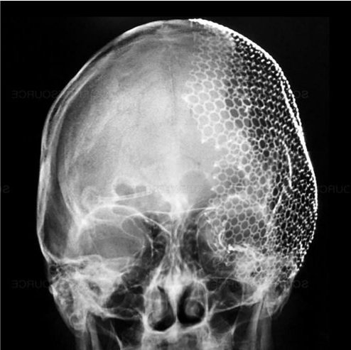 Phẫu thuật đặt lại xương sọ kết hợp tạo hình bằng lưới Titanium