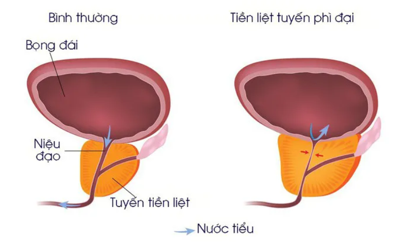 Tăng sinh lành tính tuyến tiền liệt