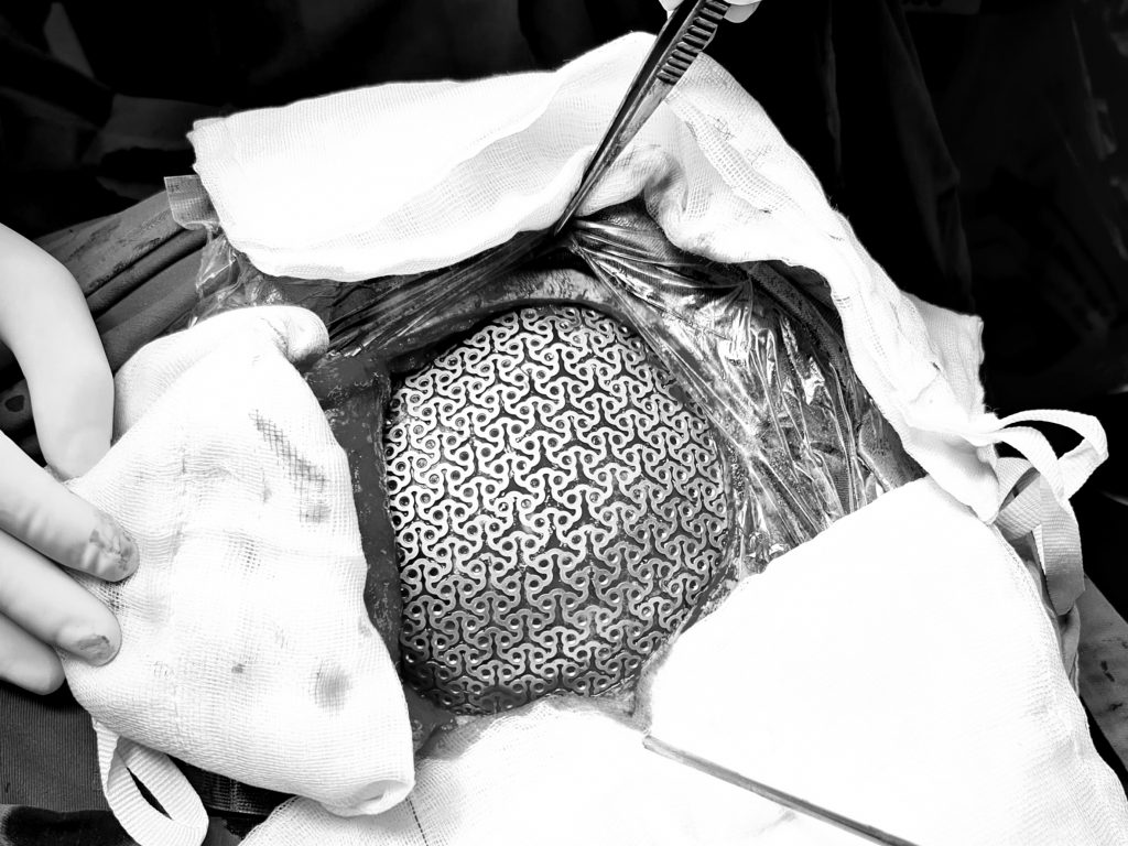 Tạo hình lưới titanium bằng công nghệ in 3D