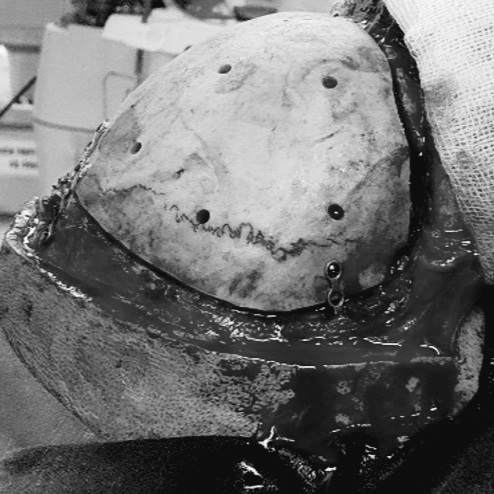 Phẫu thuật ghép sọ tự thân (đặt lại bản sọ)