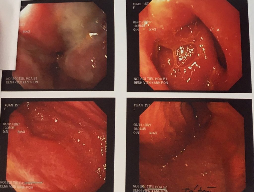 Hình ảnh nội soi dạ dày – tá tràng cho thấy nhiều ổ viêm loét niêm mạc rải khắp dạ dày, tá tràng và thực quản của bệnh nhi.