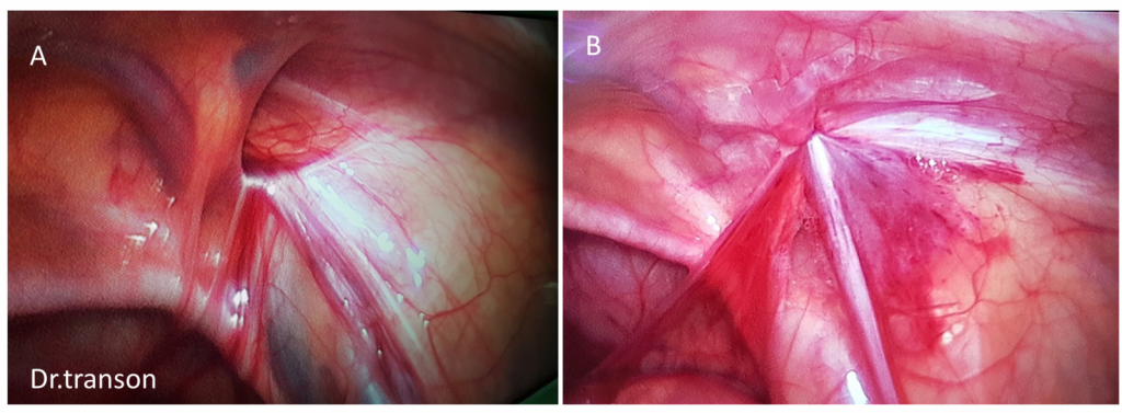 lỗ thoát vị bẹn trước (A) và sau (B) đóng với phẫu thuật nội soi 1 lỗ