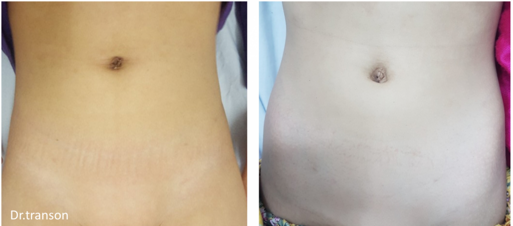 Hình ảnh thoát vị bẹn nội soi 1 lỗ không để lại sẹo và ít biến chứng