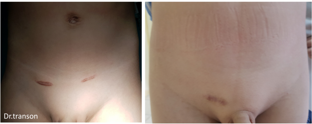 Sẹo xấu sau mổ mở thoát vị bẹn