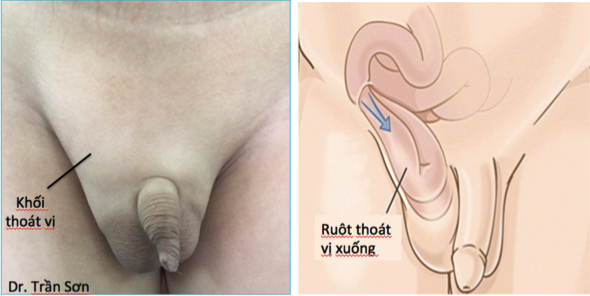 Phẫu thuật nội soi điều trị thoát vị bẹn trẻ em áp dụng đối với những trẻ từ 16 tuổi trở xuống