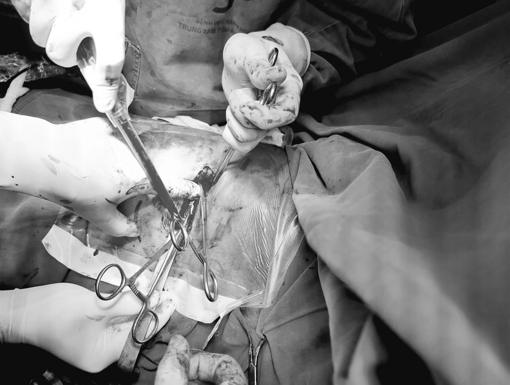 Hình ảnh máu cục màng phổi và nẹp vít xương sườn
