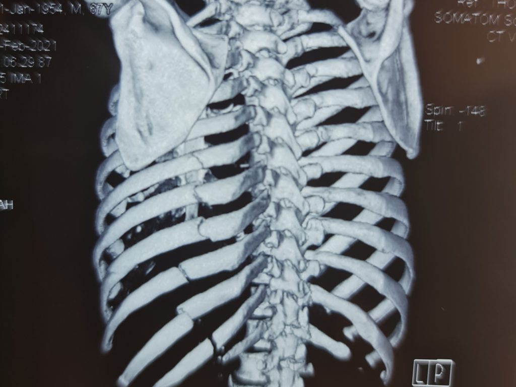 Chẩn đoán chủ yếu dựa vào phim chụp XQ ngực, CLVT có dựng hình 3D xương sườn.