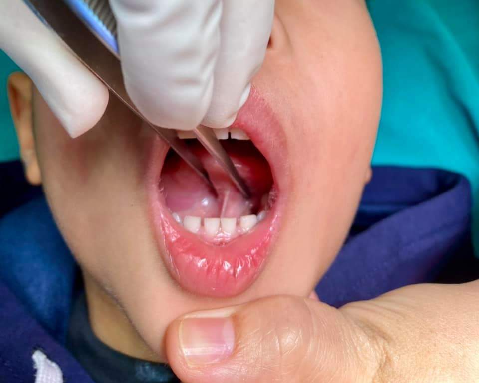 Dính thắng lưỡi