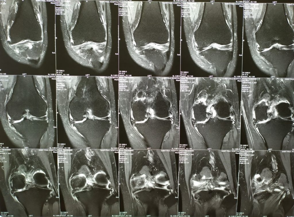 Hình ảnh thoái hóa khớp gối của bệnh nhân trên MRI