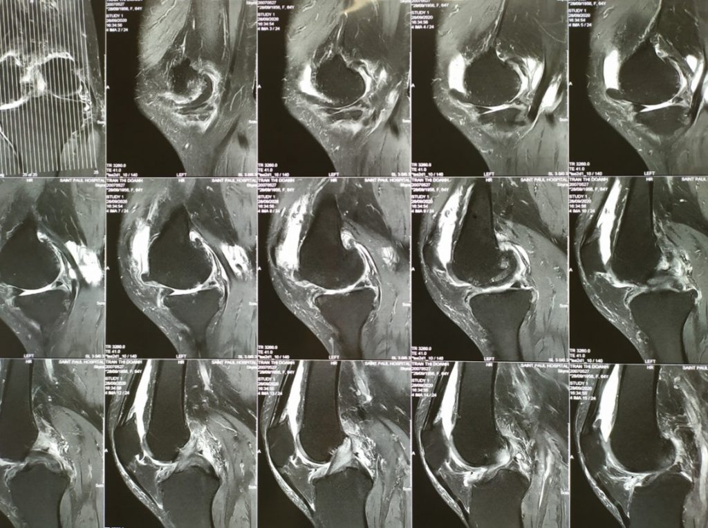 Hình ảnh thoái hóa khớp gối của bệnh nhân trên MRI