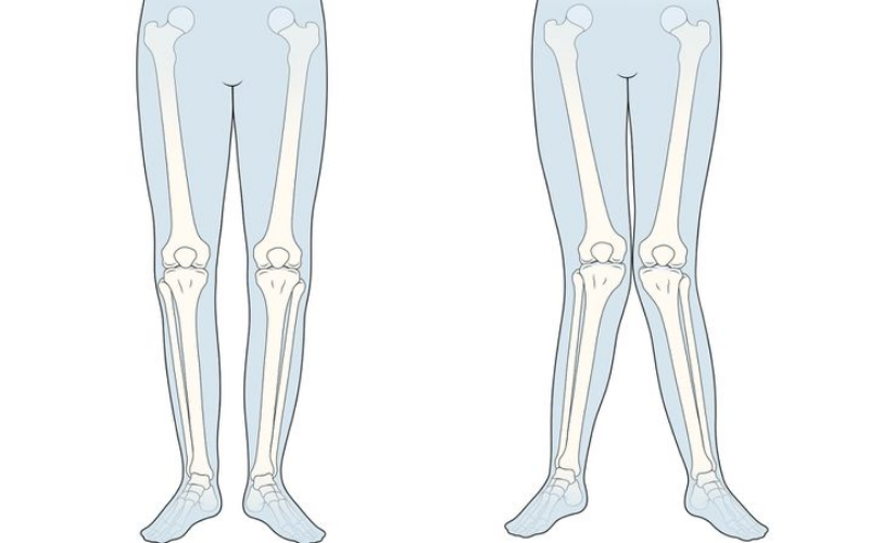 Tình trạng chân chữ X bệnh lý làm tăng nguy cơ viêm khớp