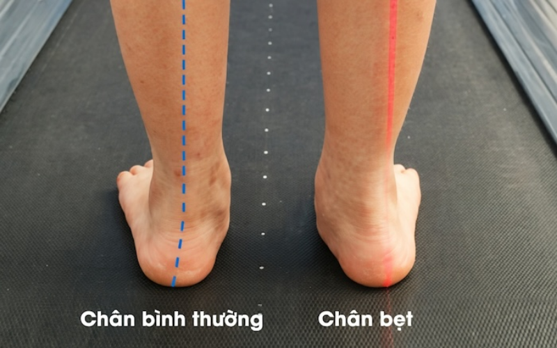 Chân chữ X thường hay kết hợp dị tật khác: bàn chân bẹt, chồi xương,…