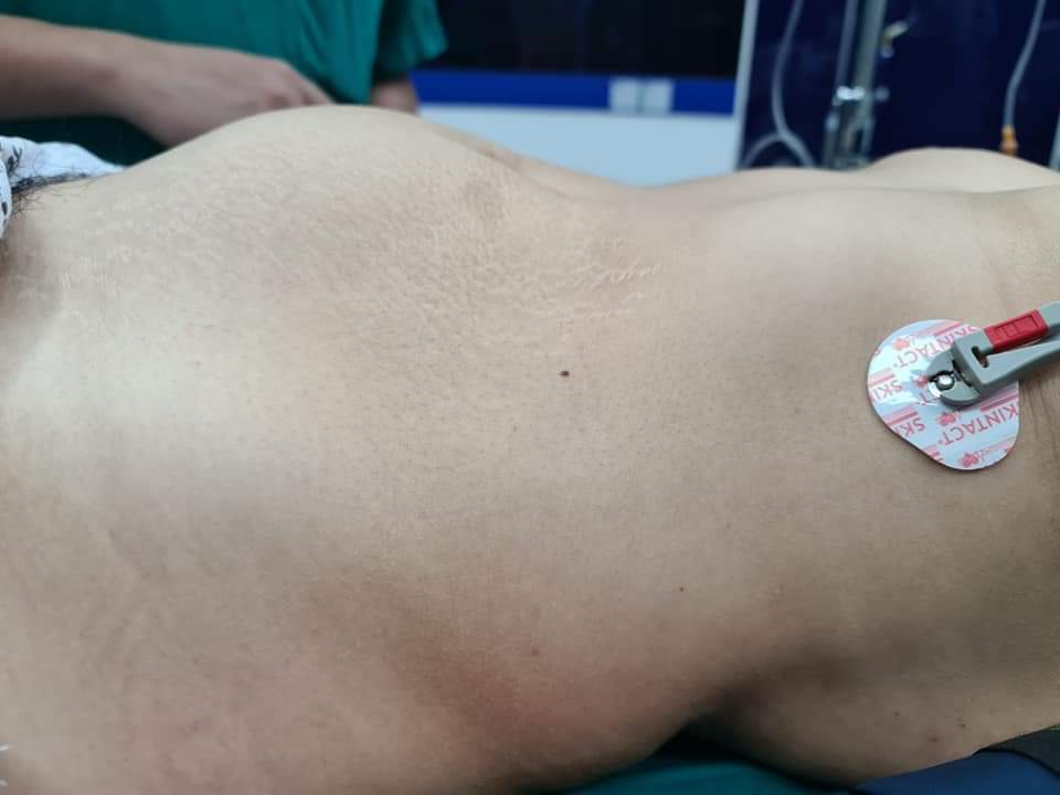 Hình ảnh thành bụng người phụ nữ trước khi phẫu thuật