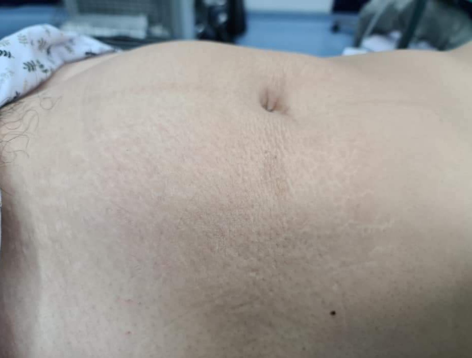 Hình ảnh thành bụng người phụ nữ trước khi phẫu thuật