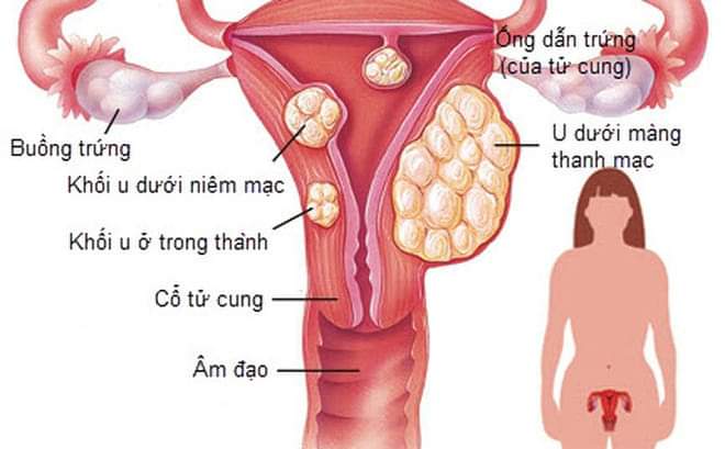 Hình ảnh minh họa U xơ tử cung