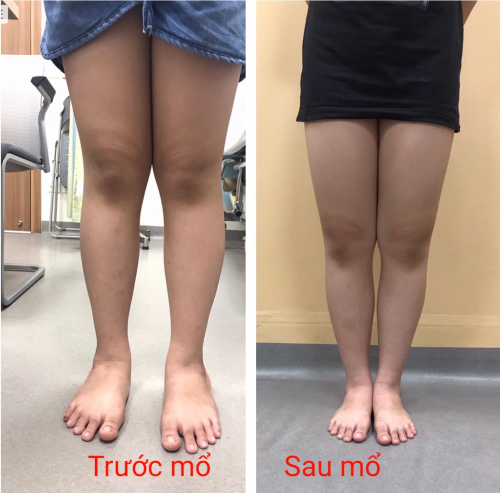 Ca bệnh của Hội chứng bàn chân bẹt