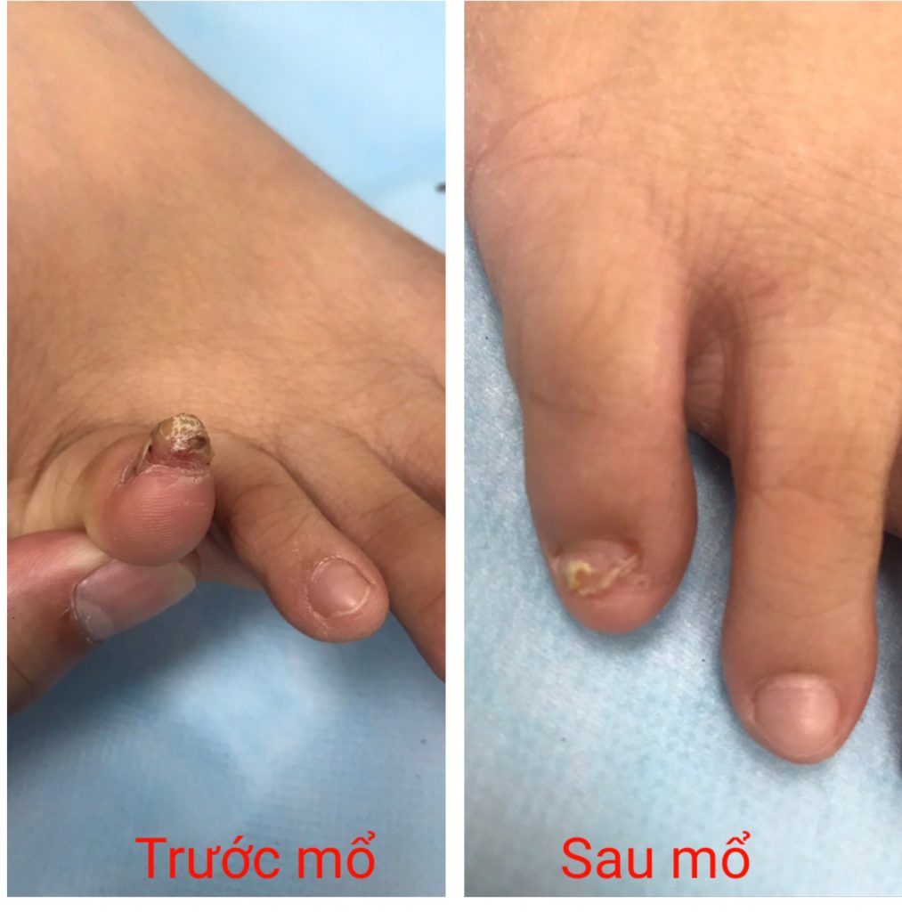 Ca bệnh của Hội chứng bàn chân bẹt