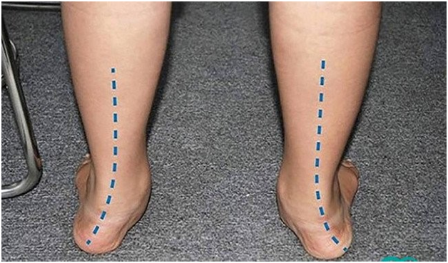 Một trong những dấu hiệu đặc trung bàn chân bẹt