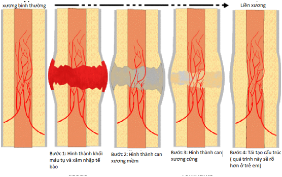 Các giai đoạn của liền xương