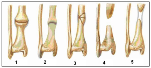 Phân loại chậm liền và khớp giả trên X-Quang