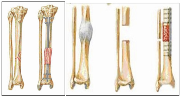 Một số cách điều trị chậm liền xương và khớp giả ở xương chầy.