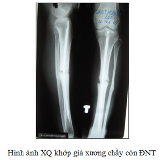 Hình ảnh chậm liền và khớp giả trên X-Quang