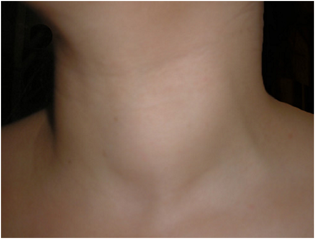 Hình ảnh thực tế người bệnh bị nhân tuyến giáp