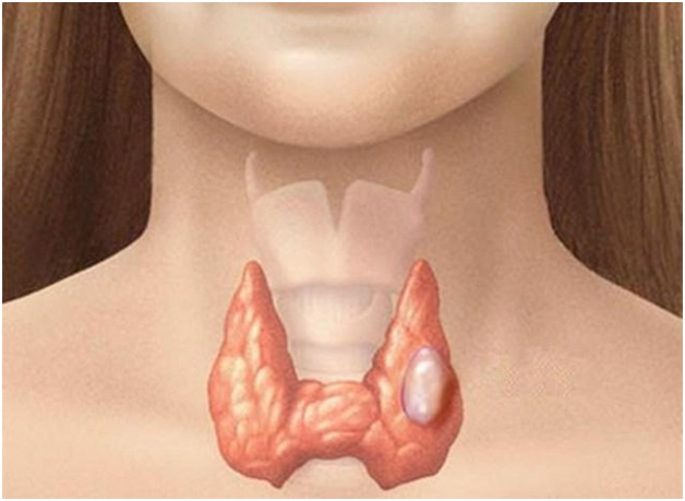 Nhân tuyến giáp biểu hiện rất đa dạng