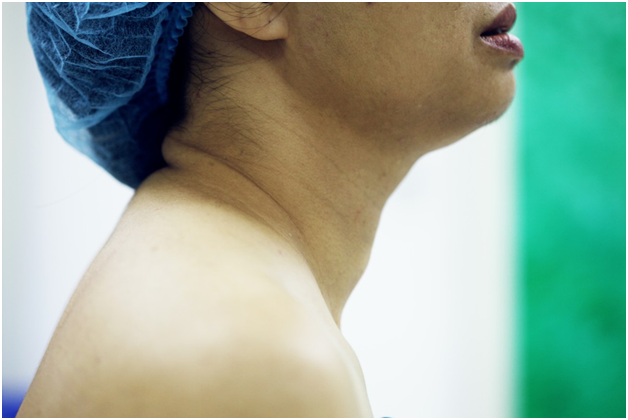 Khi nhìn nghiêng u tuyến giáp biểu hiện trên cổ