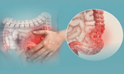 TÌM HIỂU VỀ HỘI CHỨNG RUỘT KÍCH THÍCH (IBS)