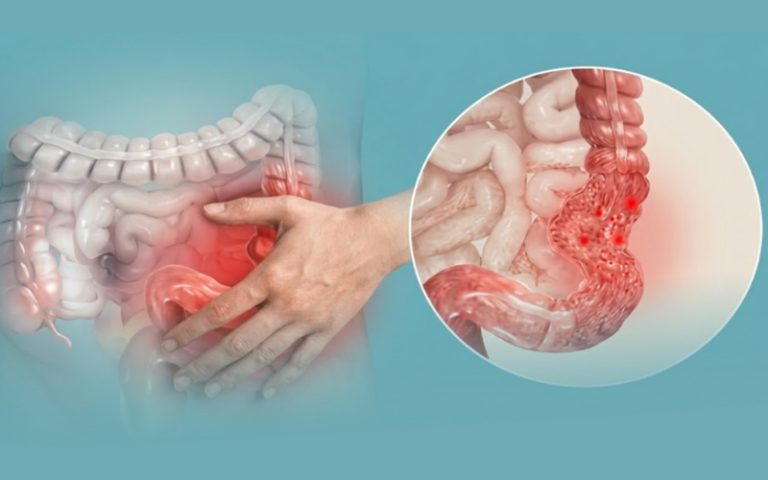 Hội chứng ruột kích thích