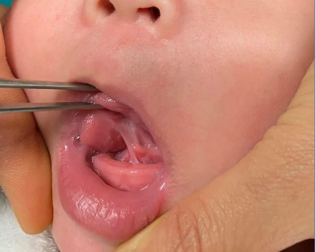 Dính thắng lưỡi 2