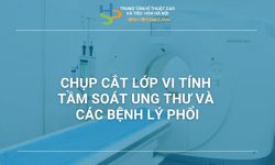 CHỤP CẮT LỚP VI TÍNH TẦM SOÁT UNG THƯ VÀ CÁC BỆNH LÝ PHỔI