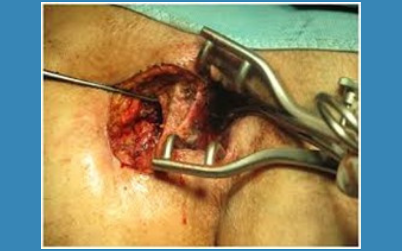 Bệnh chuyên khoa hậu môn - phẫu thuật nội soi hậu môn