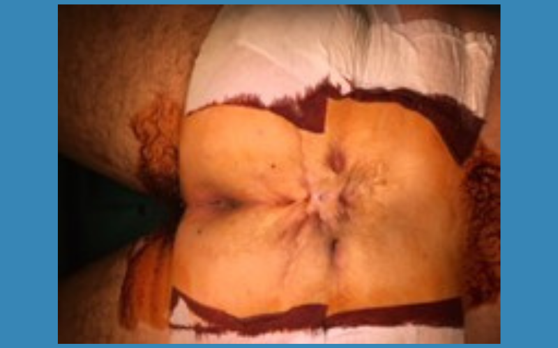 Bệnh chuyên khoa hậu môn - phẫu thuật nội soi hậu môn