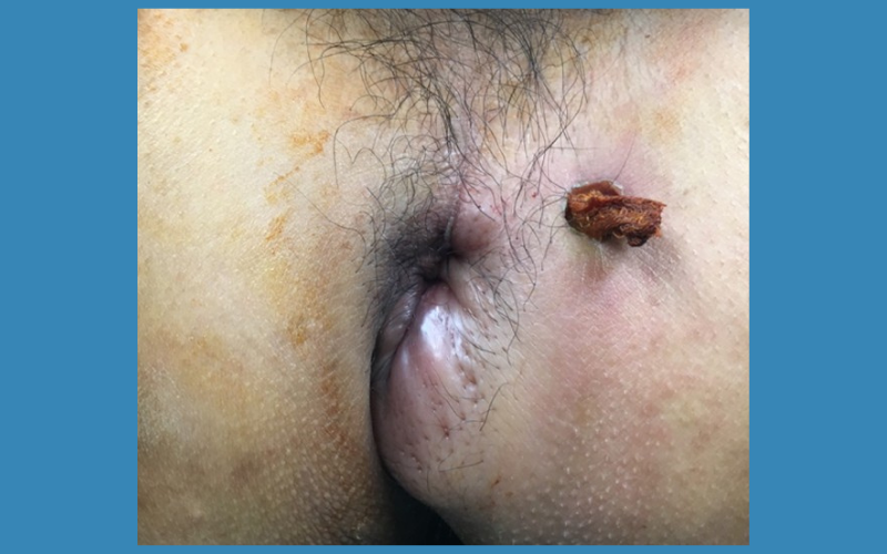 Bệnh chuyên khoa hậu môn - phẫu thuật nội soi hậu môn