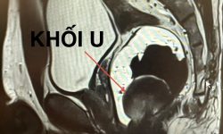 KHỐI SA VÙNG HẬU MÔN: TƯỞNG LÀ TRĨ NHƯNG HÓA RA LẠI LÀ KHỐI U