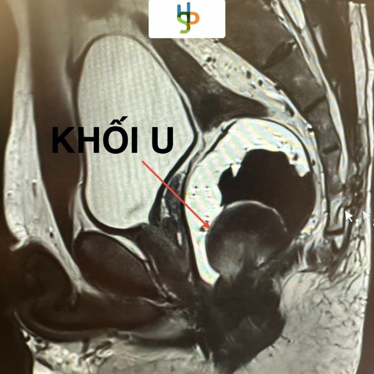 Khối sa vùng hậu môn