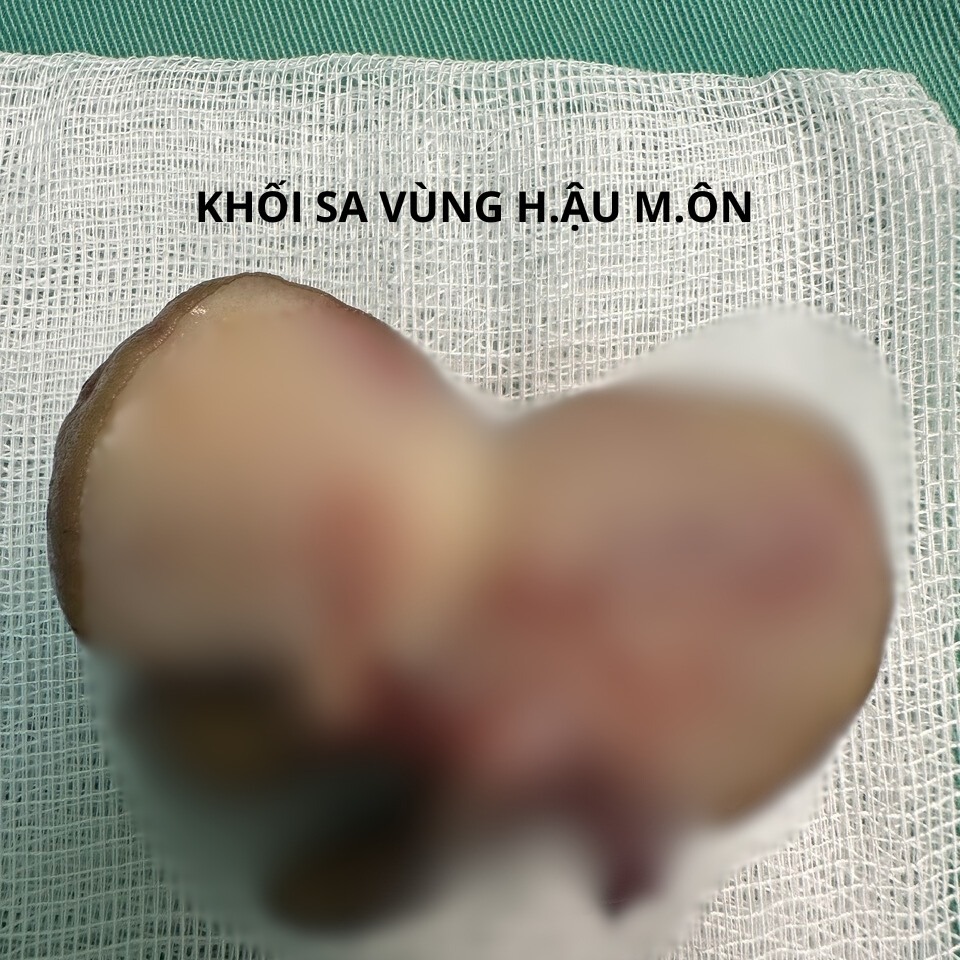 Khối sa vùng hậu môn