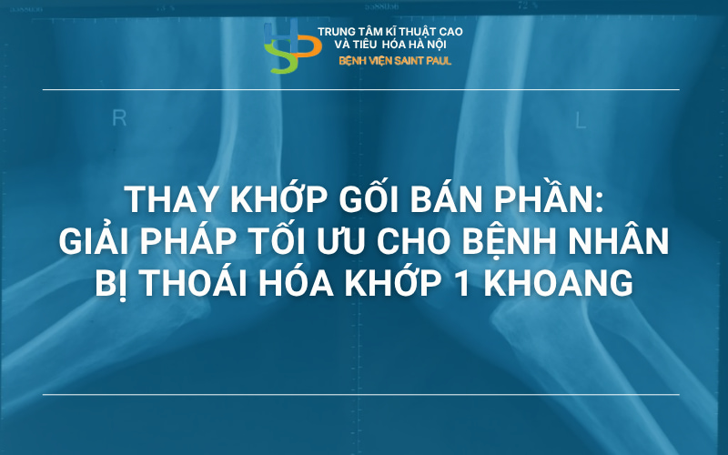 THAY KHỚP GỐI BÁN PHẦN – GIẢI PHÁP TỐI ƯU CHO BỆNH  NHÂN BỊ THOÁI HÓA KHỚP 1 KHOANG
