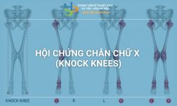 HỘI CHỨNG CHÂN CHỮ X (knock knees)