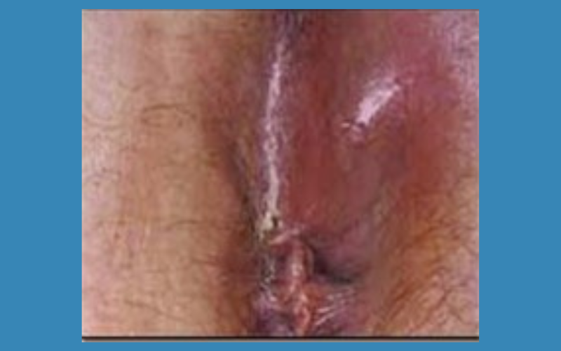 Bệnh chuyên khoa hậu môn - phẫu thuật nội soi hậu môn