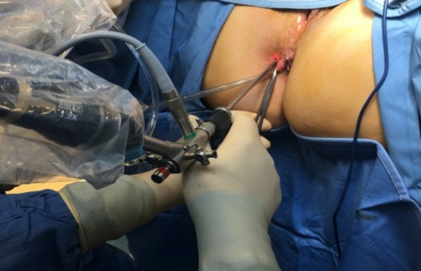 Bệnh chuyên khoa hậu môn - phẫu thuật nội soi hậu môn