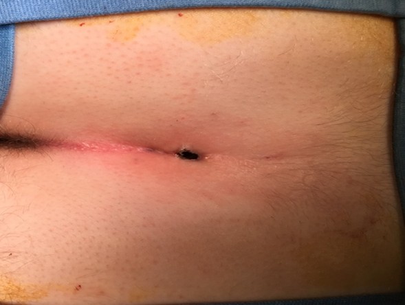 Bệnh chuyên khoa hậu môn - phẫu thuật nội soi hậu môn